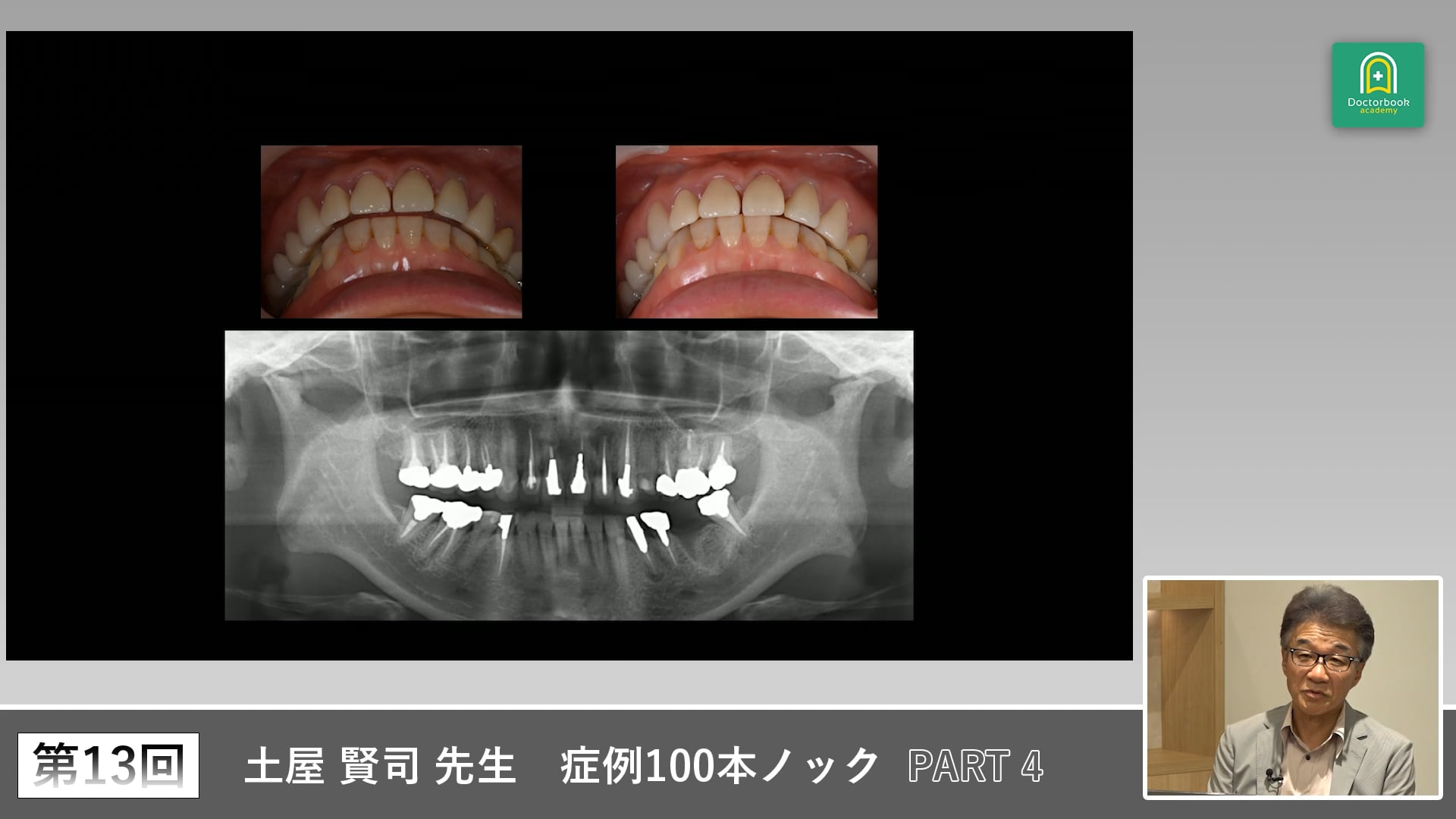 臼歯欠損が引き起こした前歯離開　咬合力と顎運動の再評価 #4