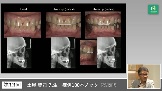 多数欠損と重度咬耗を伴う67歳女性の咬合挙上症例 #5