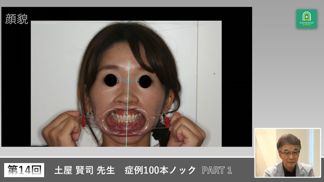 臼歯部補綴物が脱離を繰り返す34歳女性の咬合と矯正治療 #1