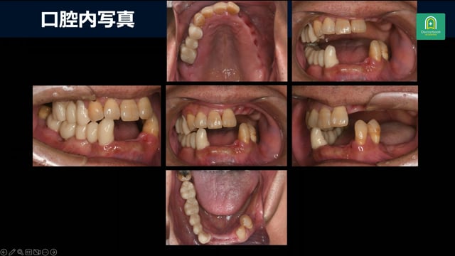 重度歯周病と咬合崩壊を伴う61歳男性の複雑な補綴設計 #2