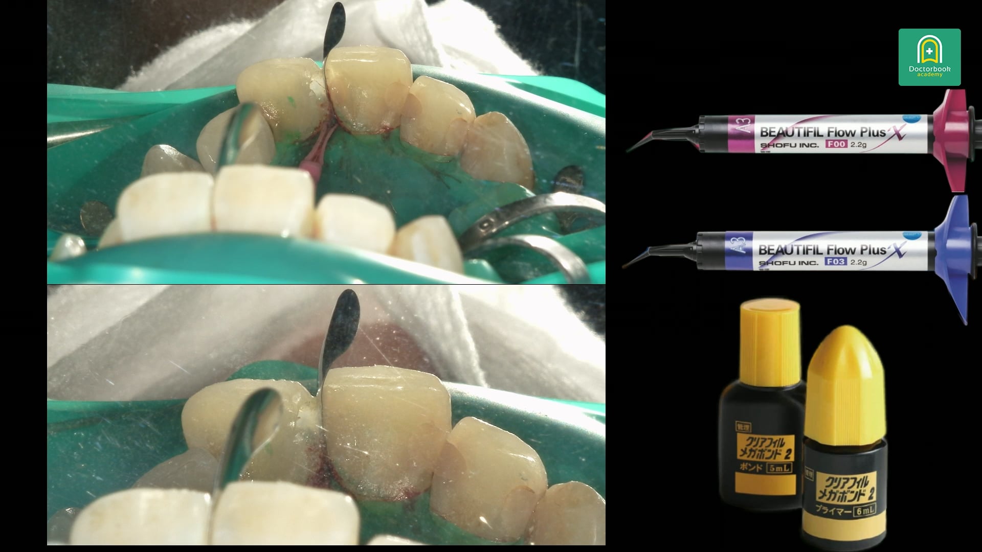 歯列不正を伴う中切歯隣接面カリエスのCR修復アプローチ #3