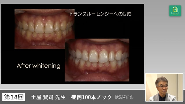 ホワイトニングを踏まえたCR修復の治療順序と注意点 #4