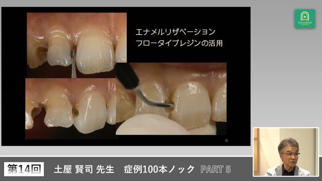 エナメルリザベーションとホワイトニングシェードに対応したCR修復 #5