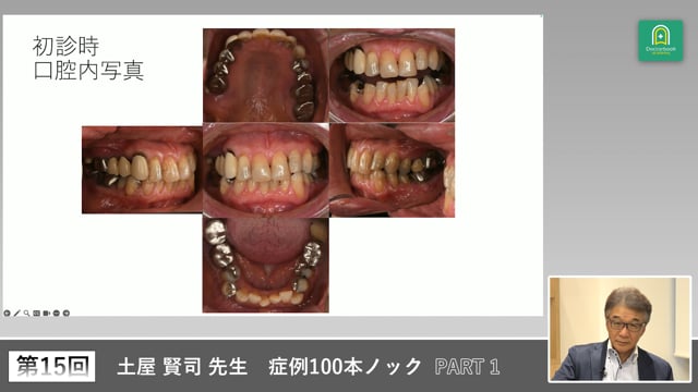 矯正とインプラントを含む全顎治療を検討する59歳女性のケース #1