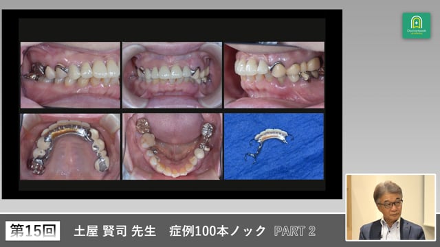 多数歯欠損を抱える77歳女性の義歯再設計と10年先を見据えた治療計画 #2