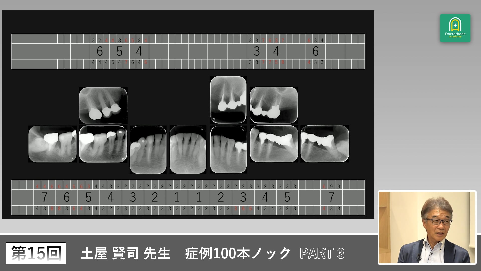 多数歯欠損症例で見直す残存歯の選択と義歯設計 #3