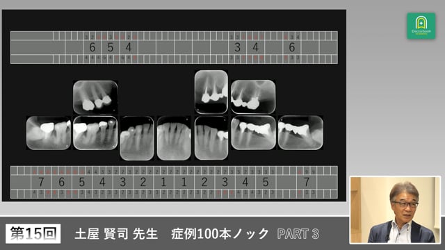 多数歯欠損症例で見直す残存歯の選択と義歯設計 #3