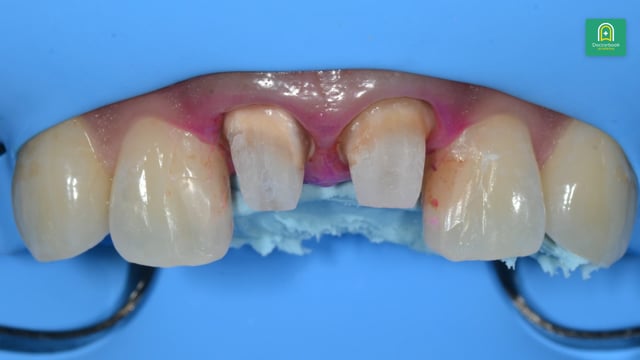 歯根近接と支台歯の短さを抱える前歯部審美補綴症例 #4
