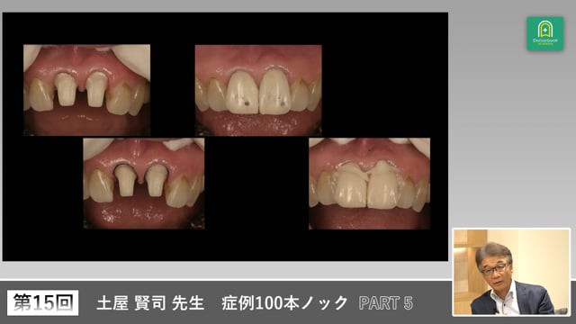 ブラックトライアングルとパピラ安定を見据えた審美修復の戦略 #5