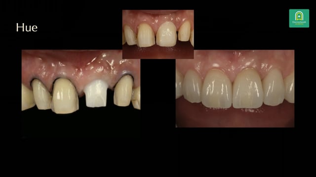 歯冠形態とガムラインを整える前歯部審美修復の実際 #2