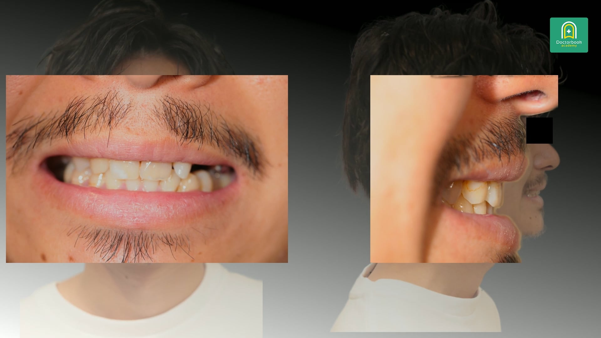 先天性欠如と矮小歯を抱える32歳男性の審美・咬合再構成症例 #3