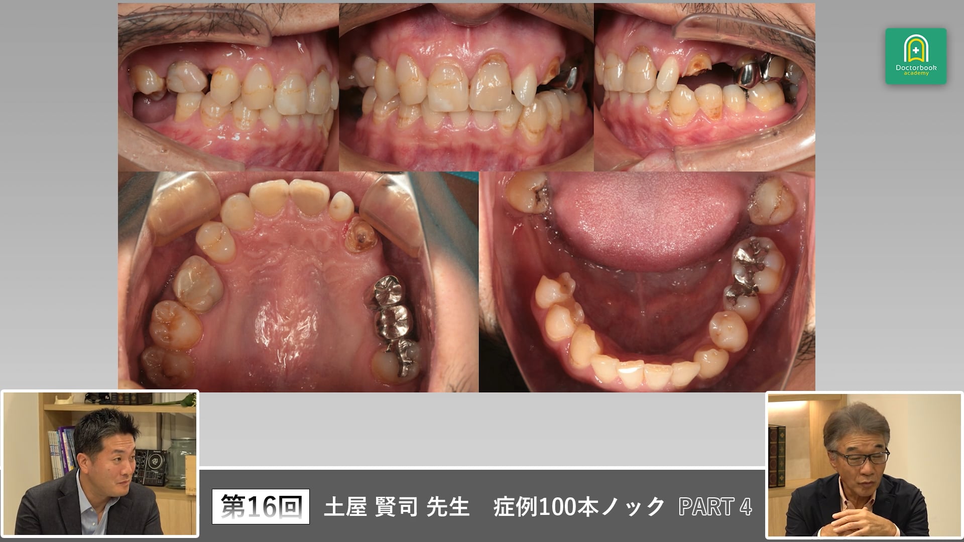 ガイド不全と咬合平面の乱れを抱える複雑欠損症例の治療戦略 #4