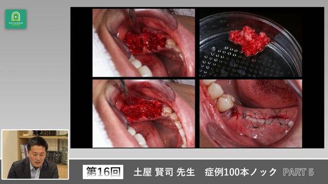 咬合平面の左右差を是正する補綴・矯正併用ケース #5
