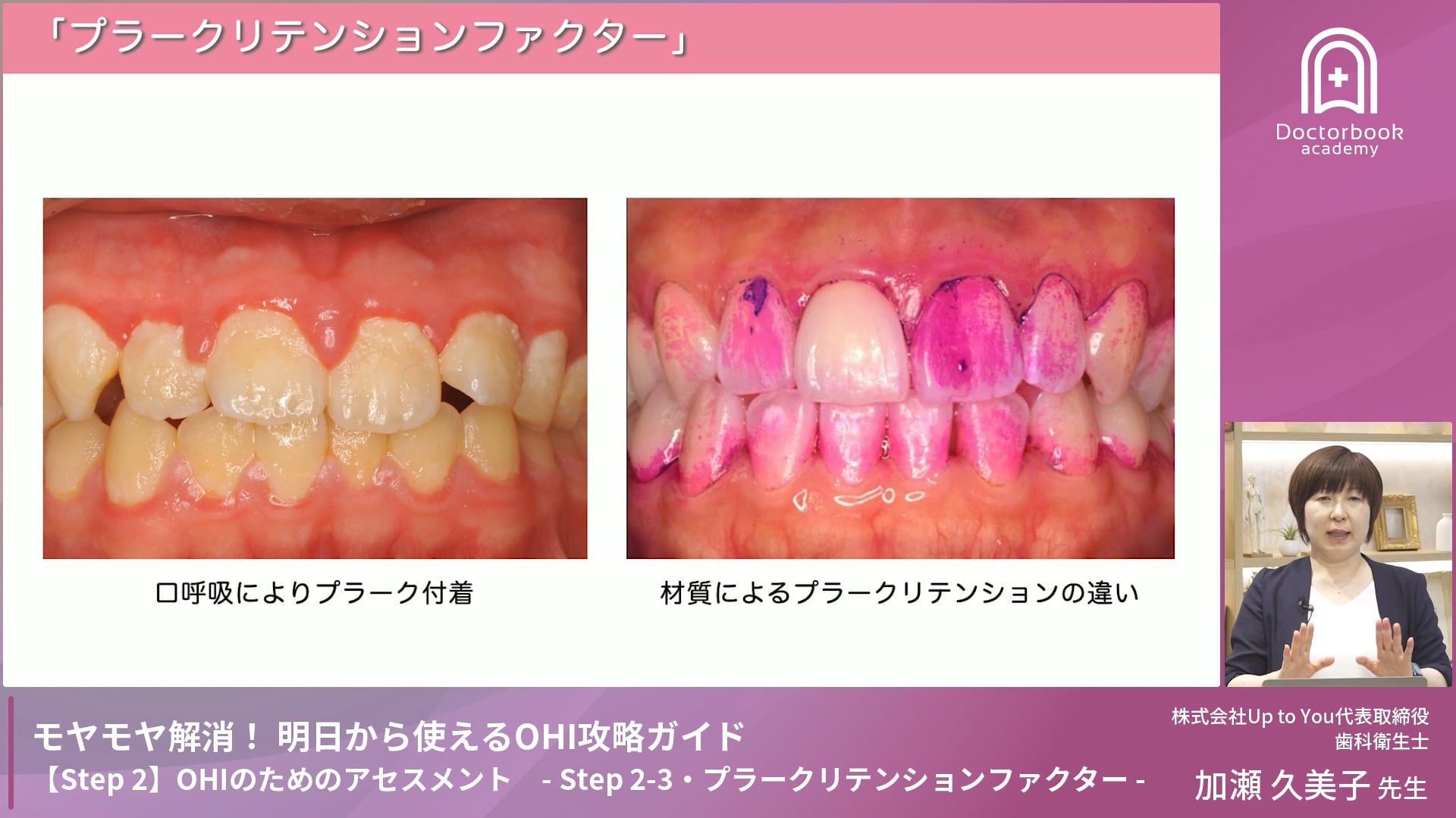Step 2-3　プラークリテンションファクター