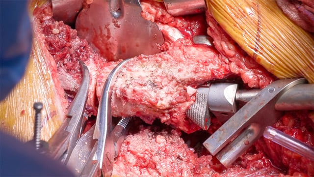 Total Hip Arthroplasty with Subtrochanteric Osteotomy for Congenital Hip Dysplasia