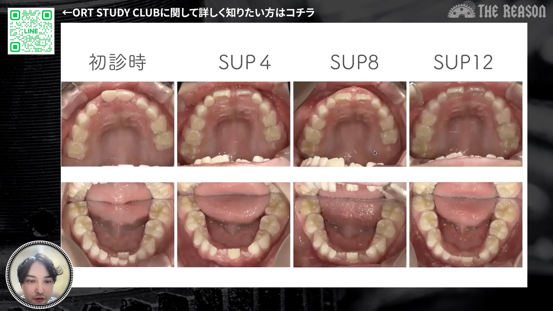 第33回 7歳ガミースマイル症例を多角的に診断する：ORT矯正の根本原因分析と治療ステップ
