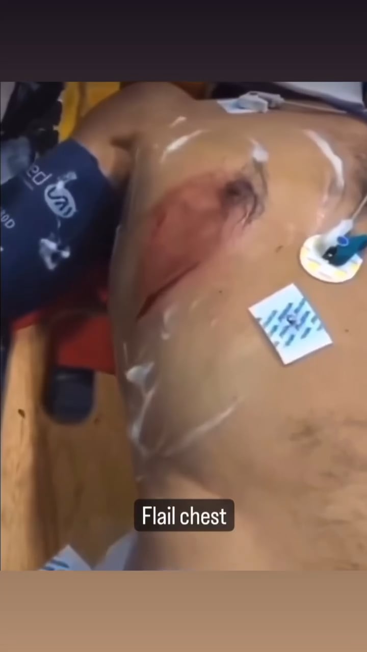 Flailed chest copy