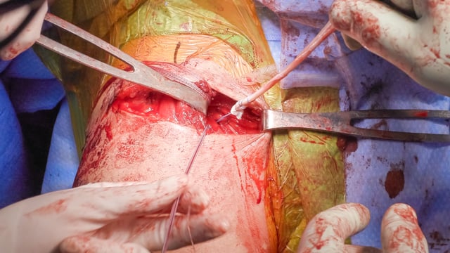 AC Joint Reconstruction Using Cortical Suture Button and Semitendinosus Allograft