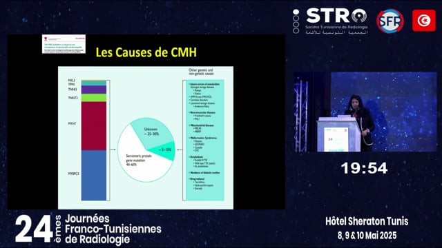 Cardiomyopathie hypertrophique primitive : ce qu’il faut savoir