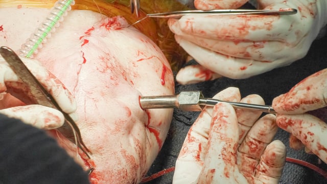 Osseointegration for Transhumeral Amputation