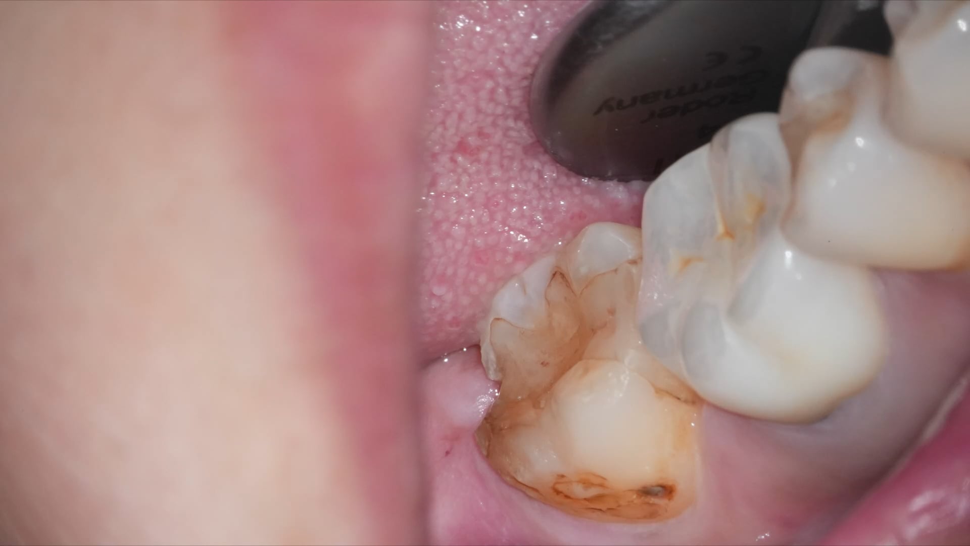 【GPB_direct-bonding_rlp_010】術前