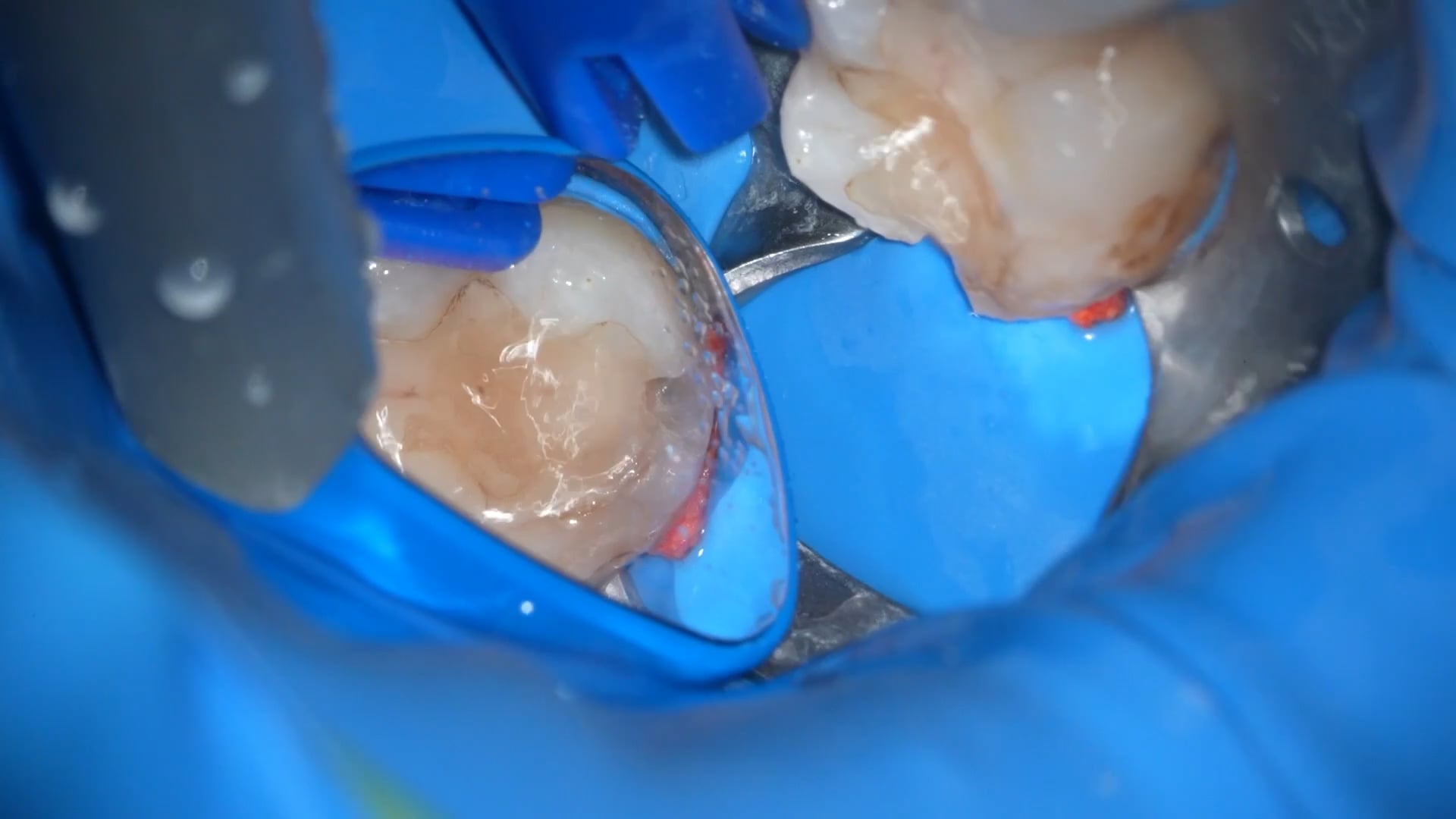 【GPB_direct-bonding_rlp_020】う蝕除去