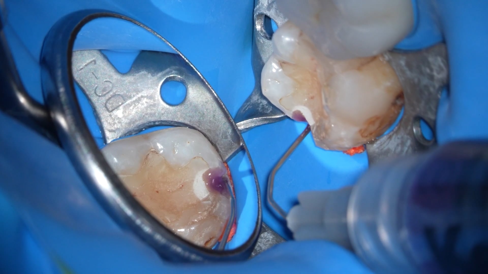 【GPB_direct-bonding_rlp_030】前処理