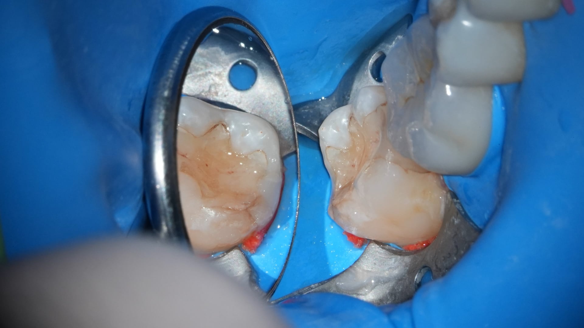 【GPB_direct-bonding_rlp_050】術後