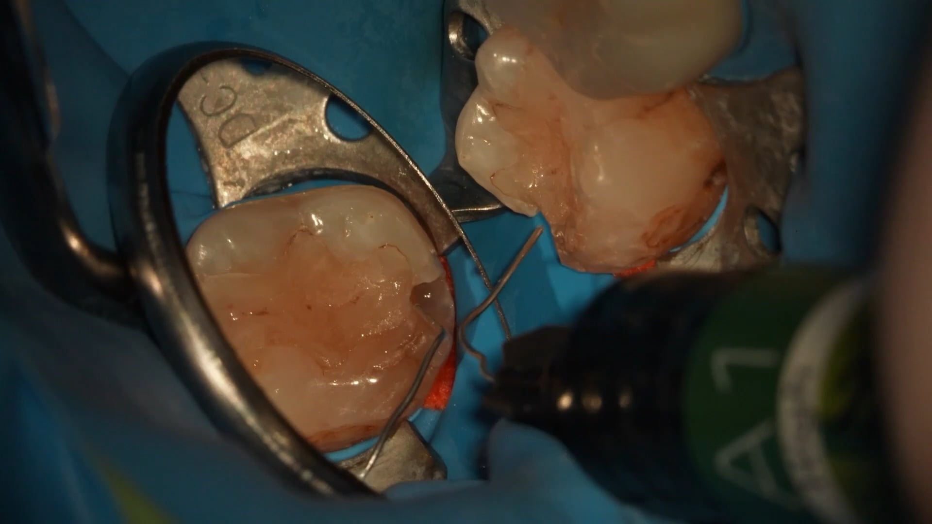 【GPB_direct-bonding_rlp_040】充填