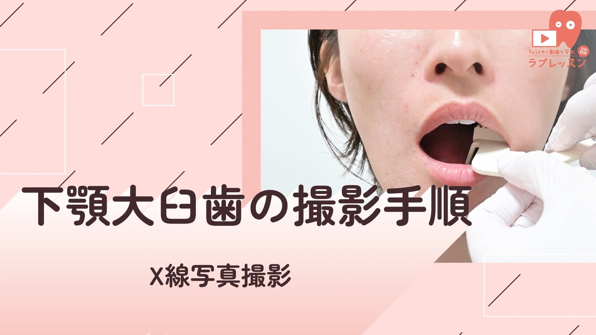 03.下顎大臼歯の撮影手順