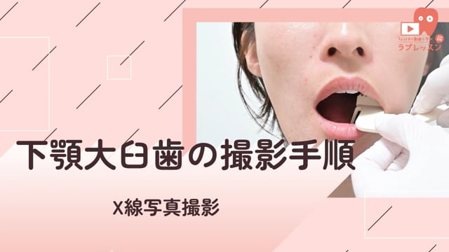 03.下顎大臼歯の撮影手順