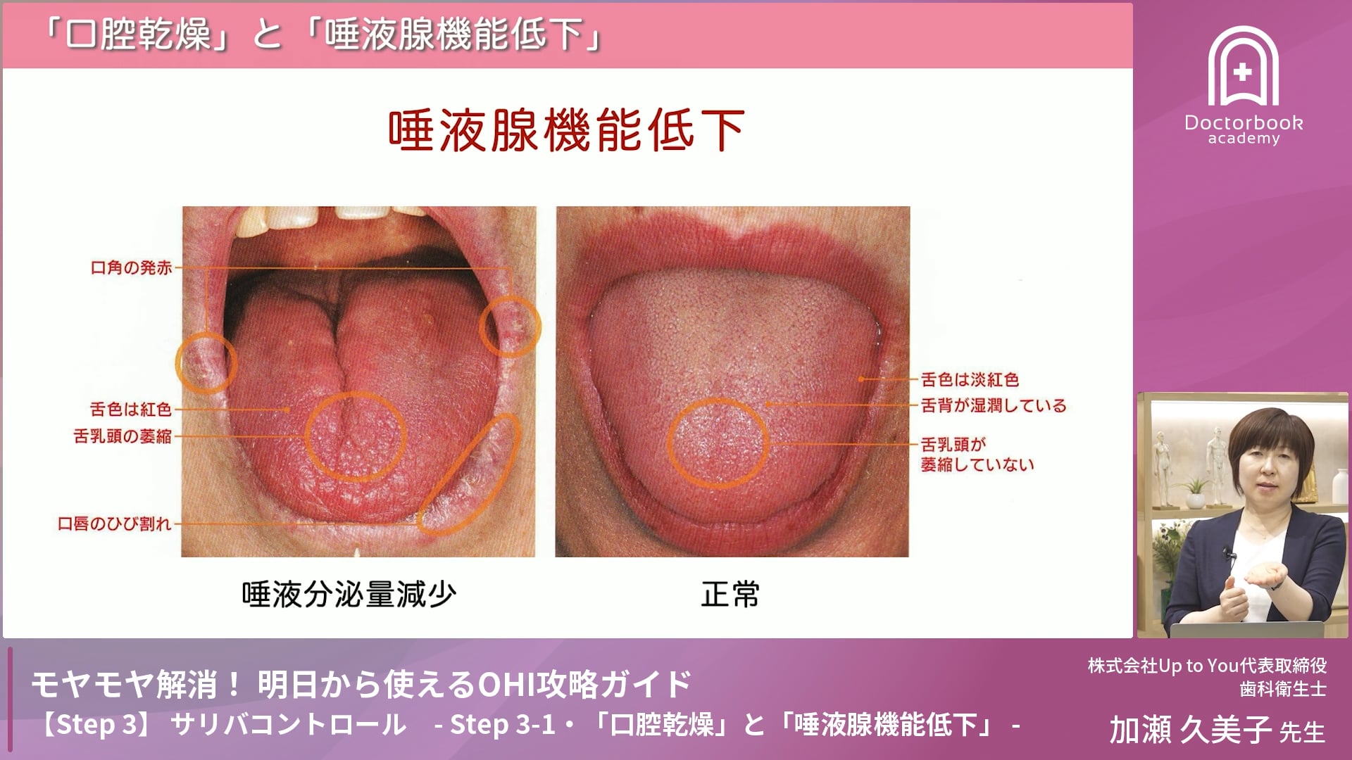 Step 3-1　「口腔乾燥」と「唾液腺機能低下」