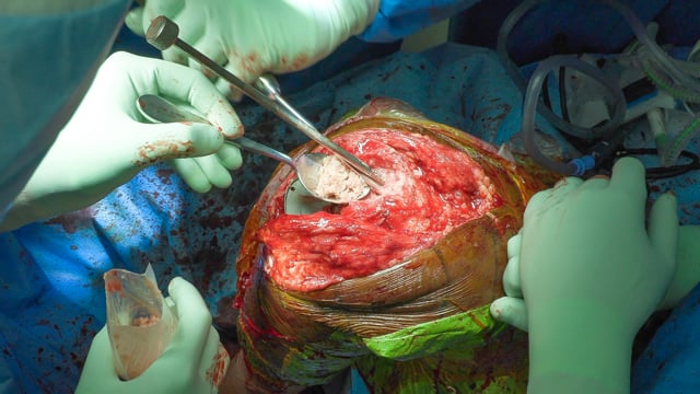 Impaction Bone Grafting for the Multiply Revised TKA