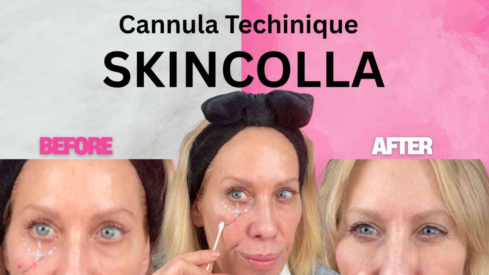 SkinColla Recombinant Collagen — Cannula with Under-Eye Updates