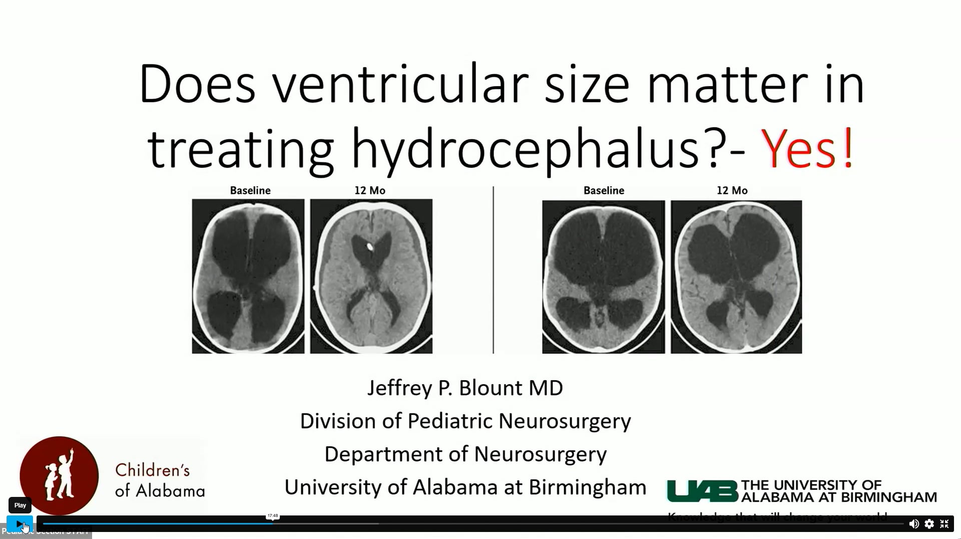 Does Ventricle Size Matter in Treating Pediatric Hydrocephalus? Yes!