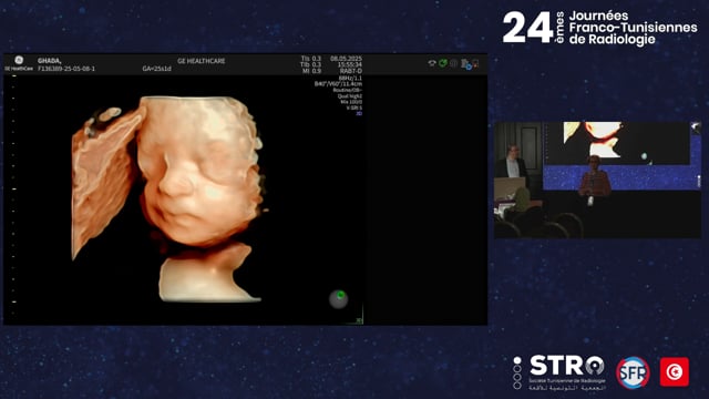 Échographie morphologique T2