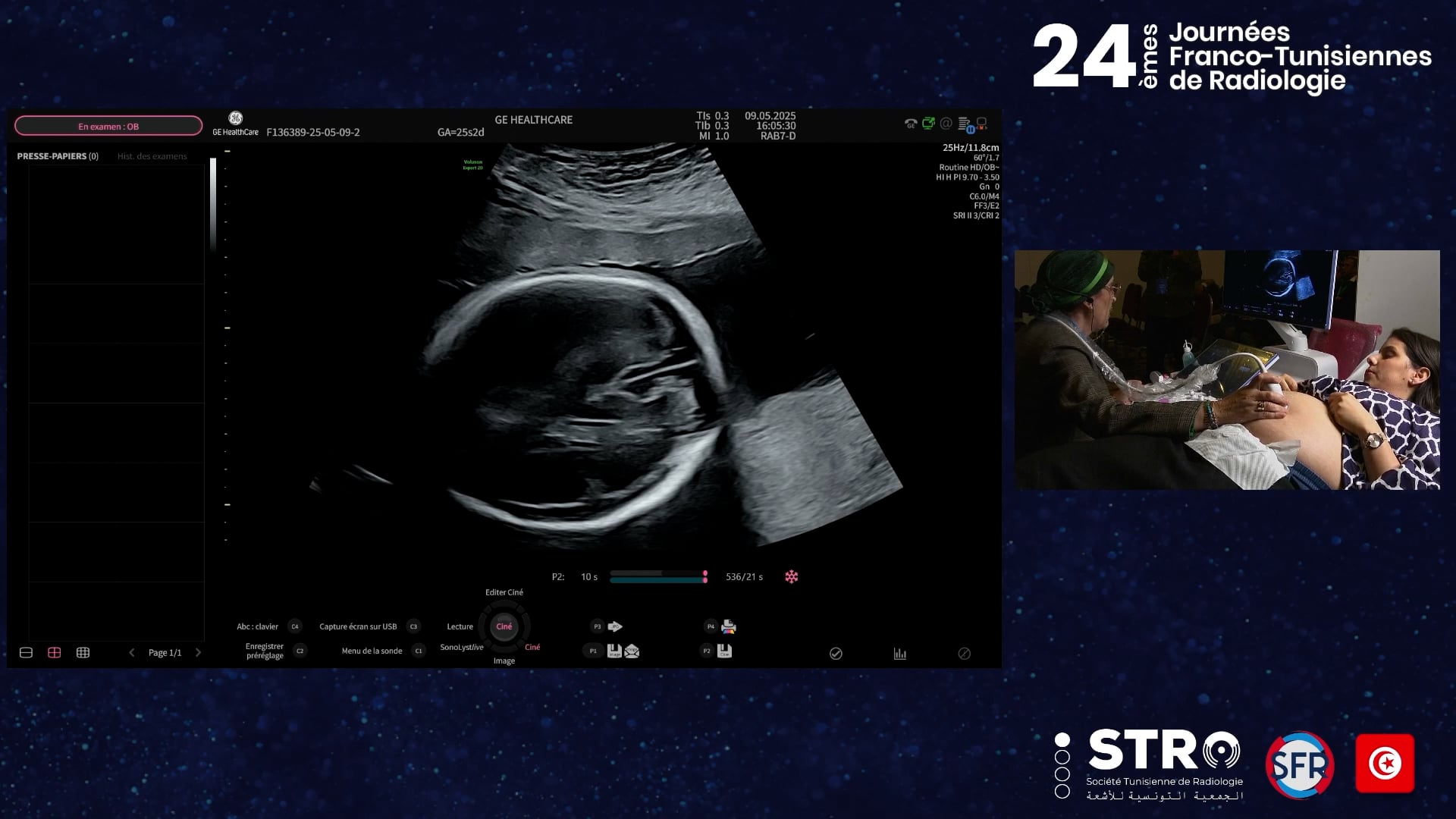 Échographie morphologique T2