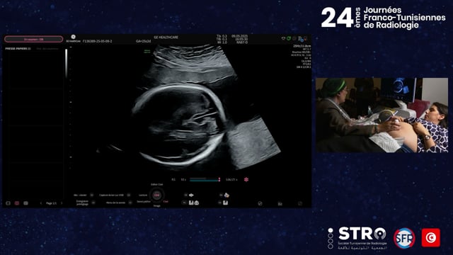 Échographie morphologique T2