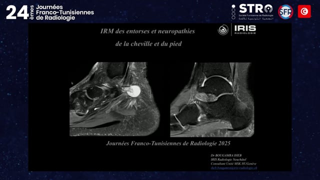 entorses de la cheville et neuropathie du pied: discussion de cas cliniques IRM