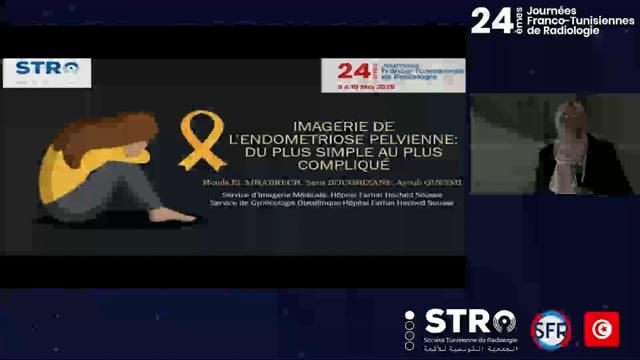 Imagerie de l’endométriose pelvienne : du plus simple au plus compliqué