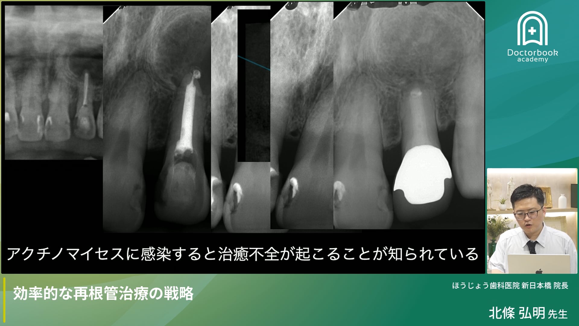 効率的な再根管治療の戦略