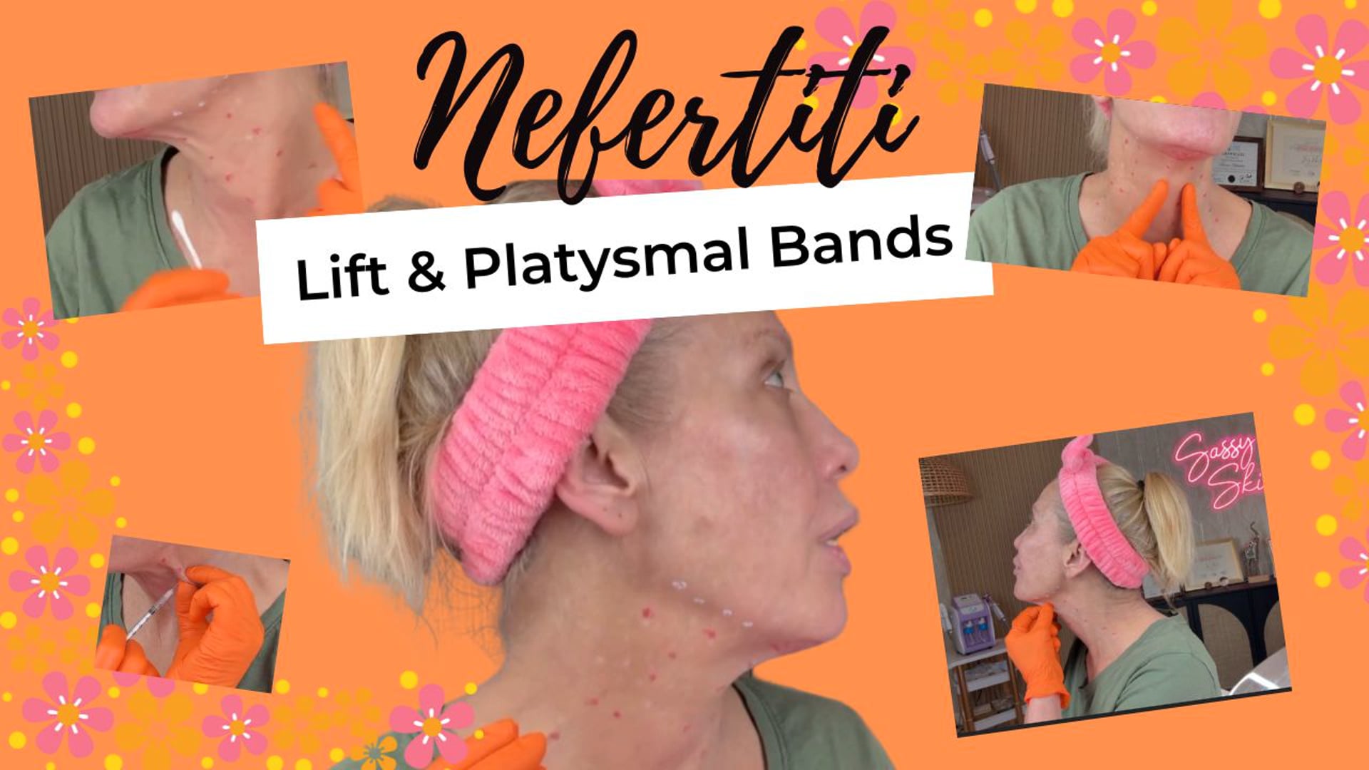 Lower Face Lift Without Surgery: Nefertiti Lift + Platysmal Bands