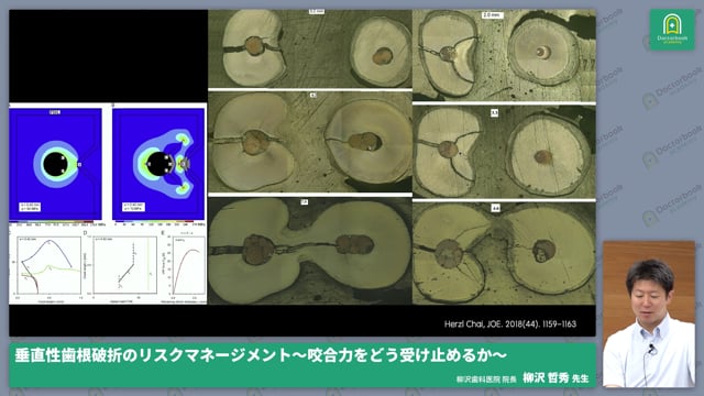 垂直性歯根破折のリスク軽減の勘所 〜咬合力をどう受け止めるか〜