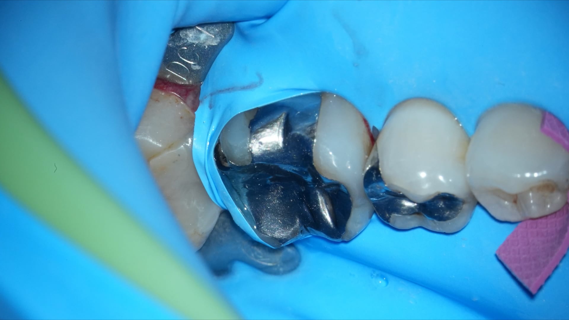 【GPB_crown_llp_020】ラバーダム装着