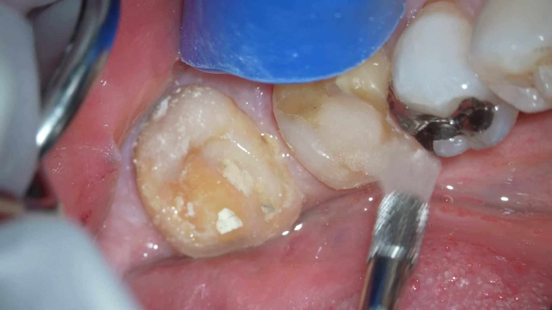 【GPB_crown_llp_0110】補綴物セット