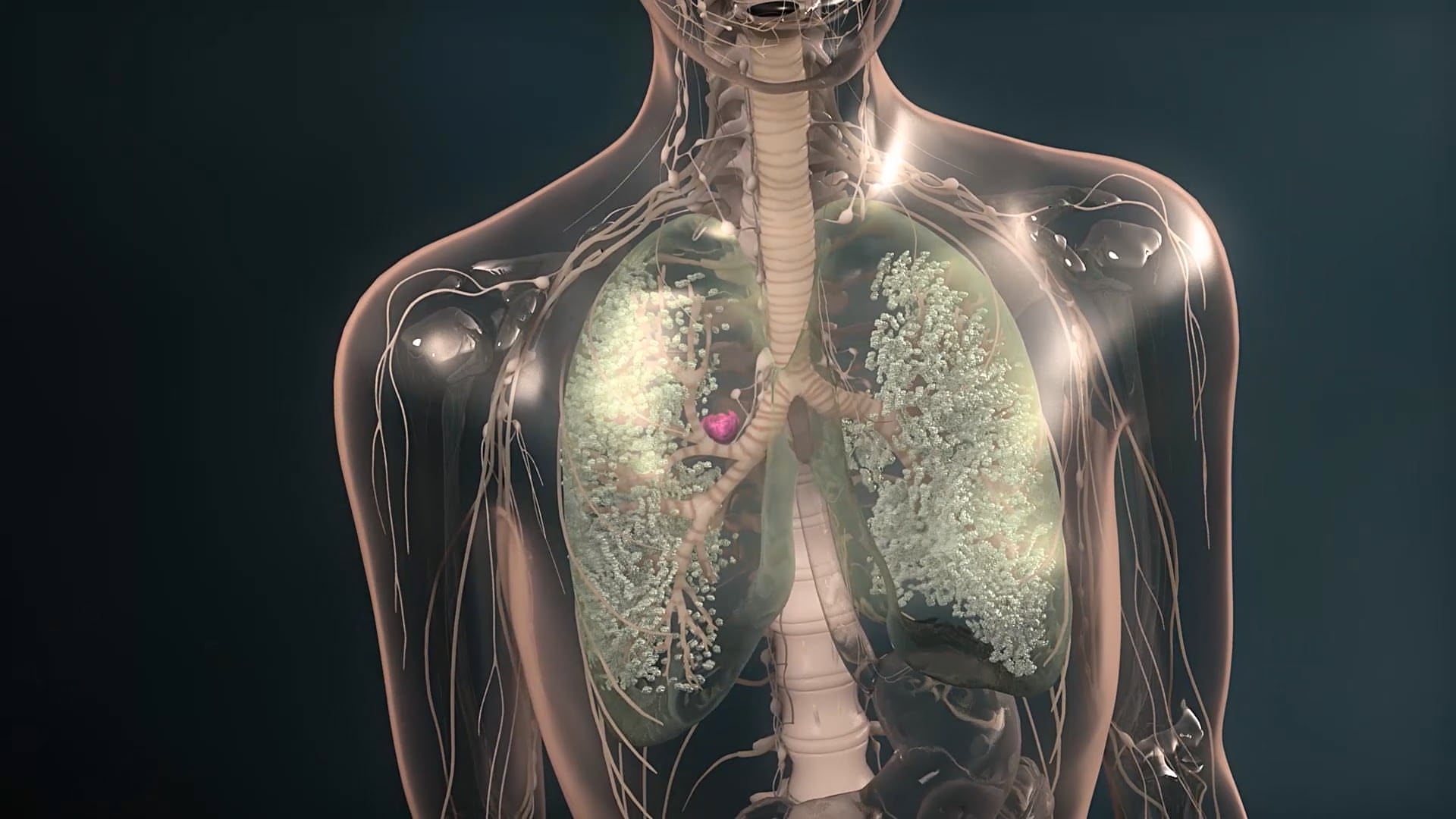 B551127_Astra_Zeneca_Tagrisso_Video_en-US_15m_OUTLINE_PAPER_EDIT_2024_1114_Part2