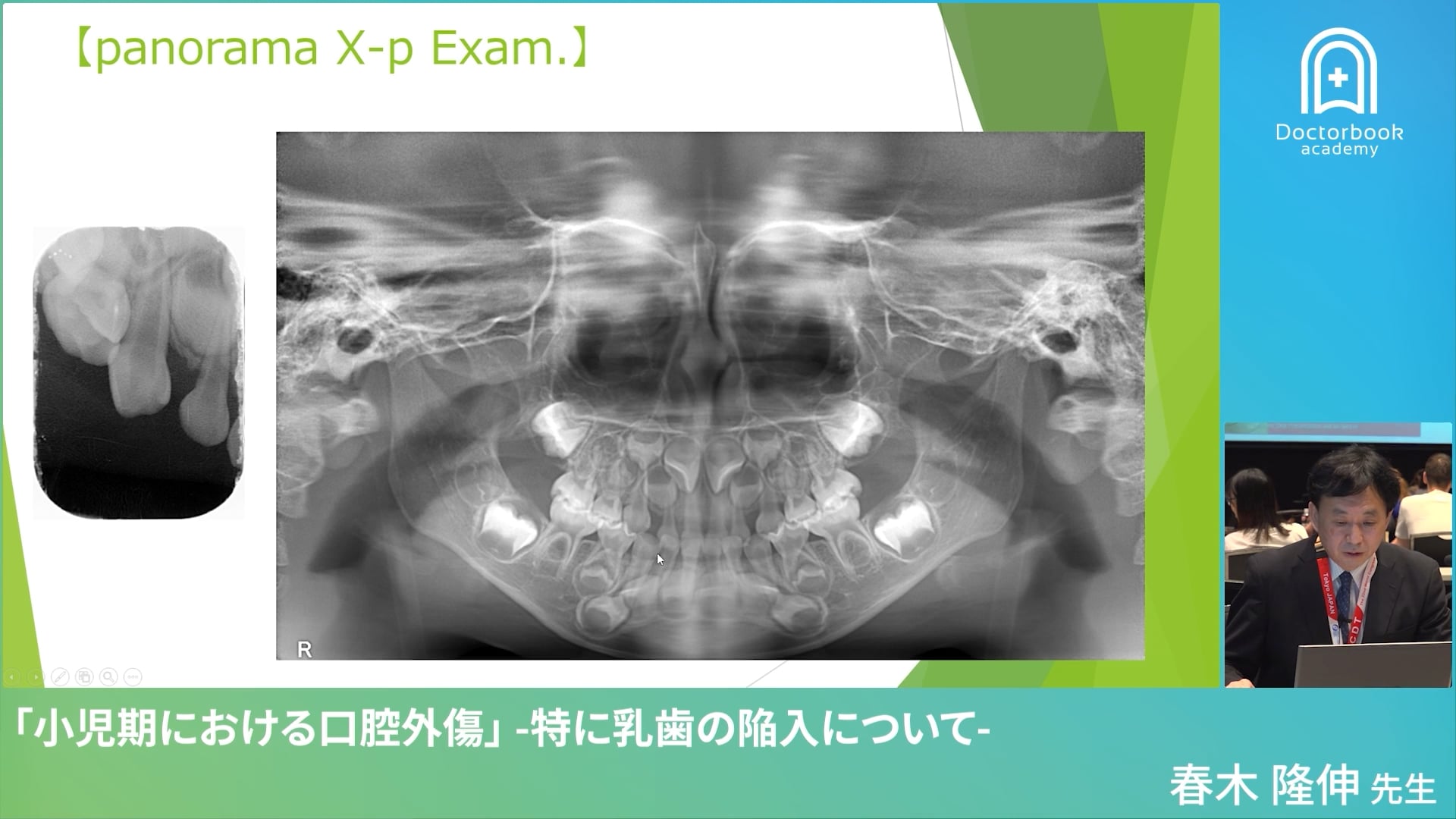  臨床知見録_小児の外傷_パノラマ