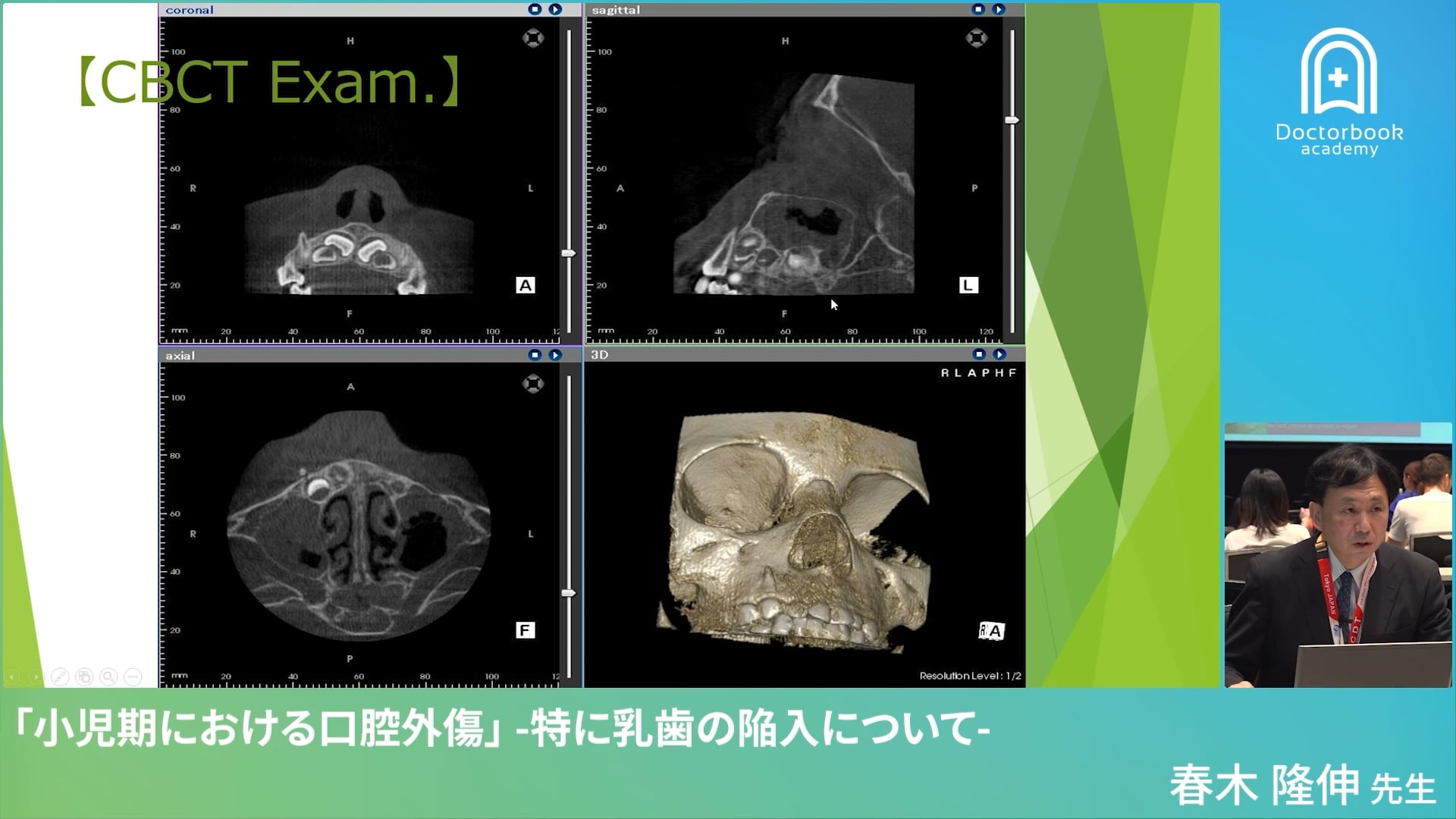  臨床知見録_小児の外傷_CBCT