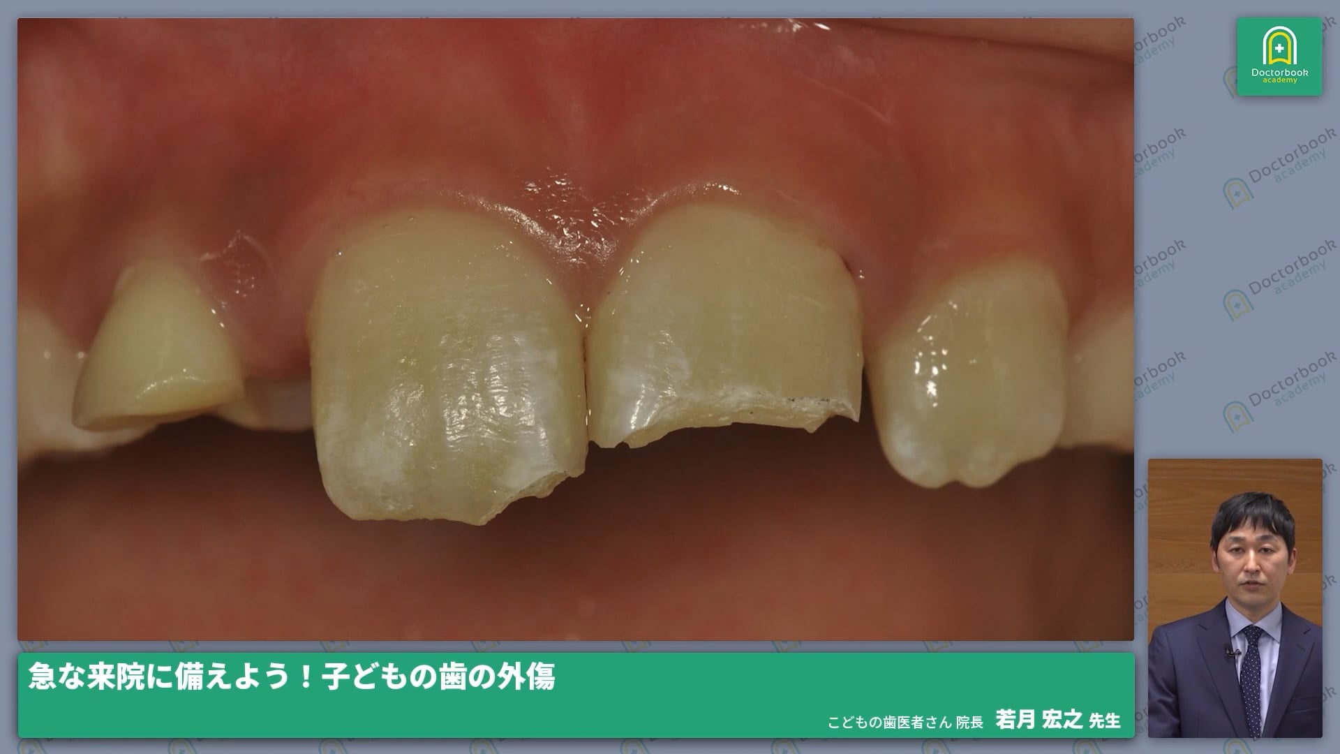  臨床知見録_小児の外傷_露髄を伴う歯冠破折