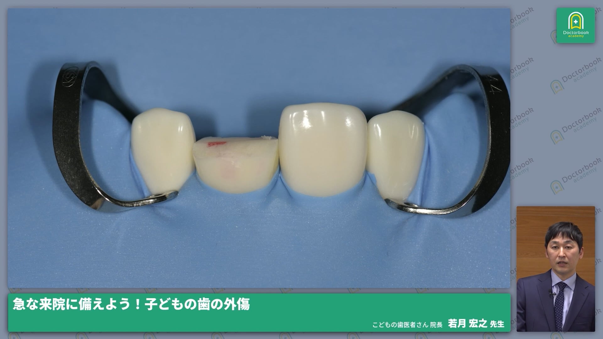  臨床知見録_小児の外傷_部分歯髄切断